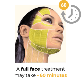 Image showing the areas of a face and neck that can be treated with Ultherapy® which may take ~60 minutes