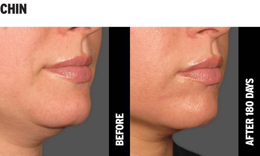 Ultherapy® treatment before and after photographs showing jowls definition results after 6 months.
