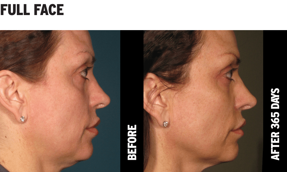 Ultherapy® treatment before and after photographs showing full face and neck lift results after 1 year.