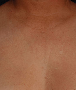 Decolletage - after